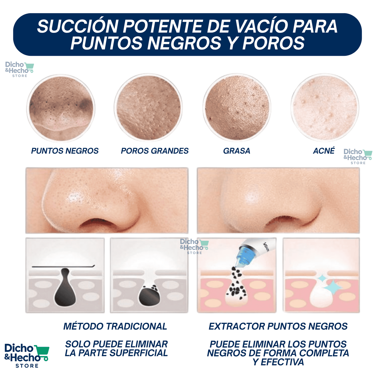 SUCCIONADOR DE PUNTOS NEGROS